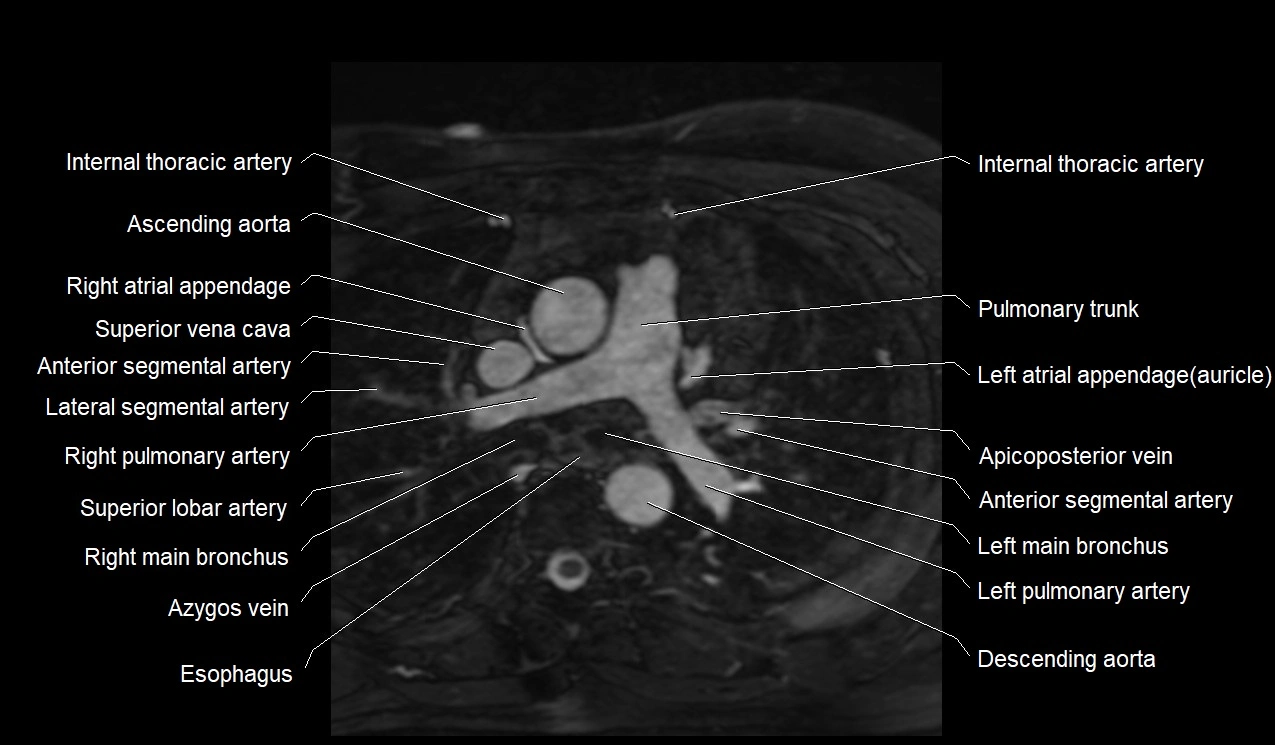MRI heart coronary arteries and coronary veins anatomy axial image 4.webp